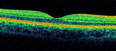 Exame de OCT  da retina normal.
